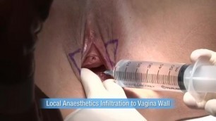 Real Vaginal Surgery
